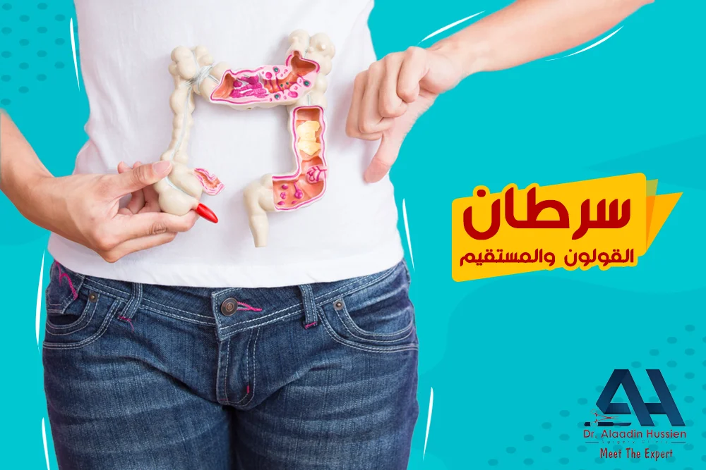 أعراض سرطان القولون المبكرة