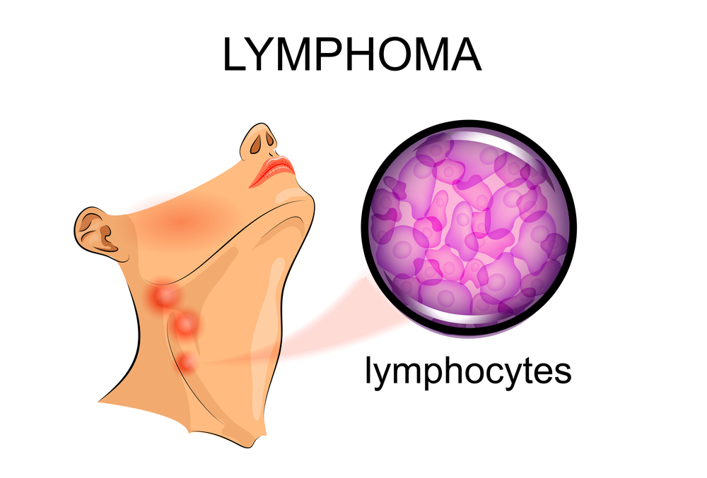 تعريف الغدد الليمفاوية و وظائفها وما هي أنواع الأورام التي تصيبها