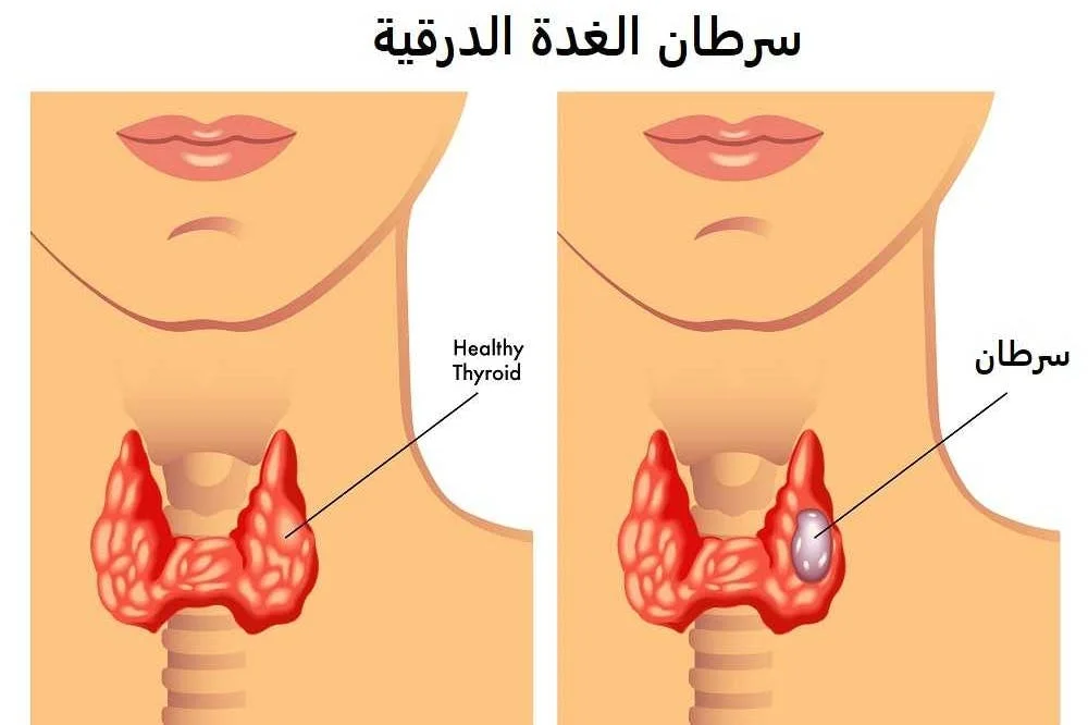 أنواع الجراحات لأورام الغدة الدرقية وشرح لأهم مضاعفاتها