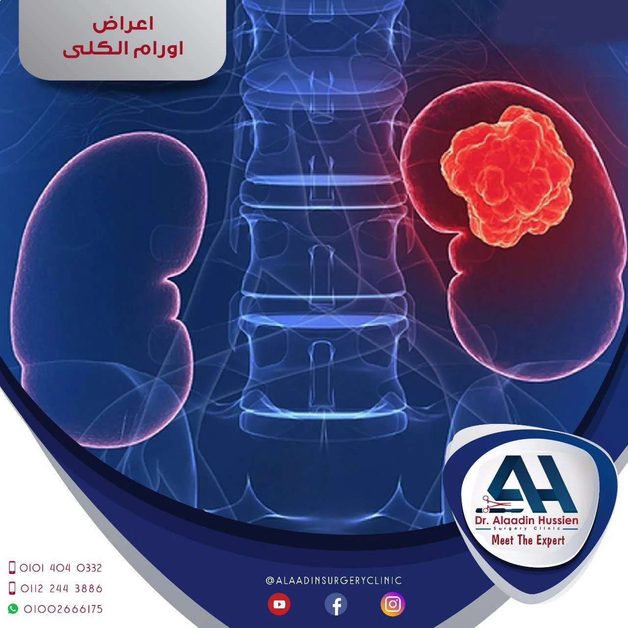 أعراض أورام الكلي دكتور علاء الدين حسين