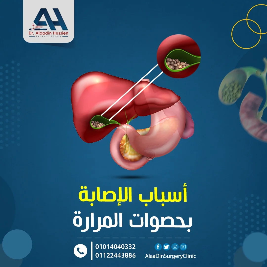اسباب حصوات المرارة