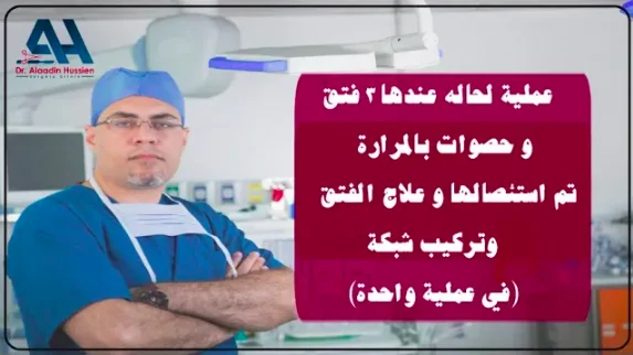 عملية صعبة لحالة عندها ٣ فتق وحصوات المرارة