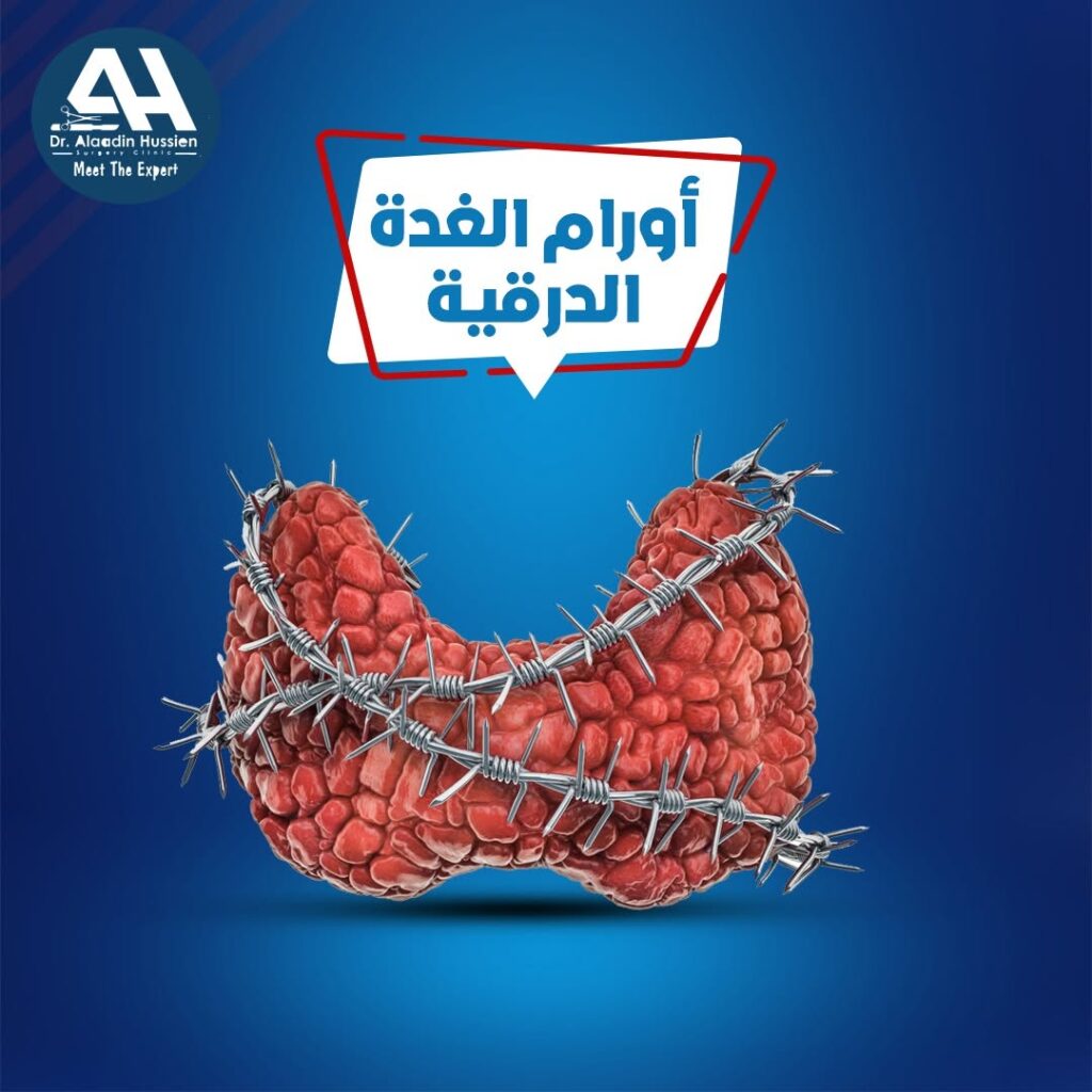 علاج سرطان الغدة الدرقية

