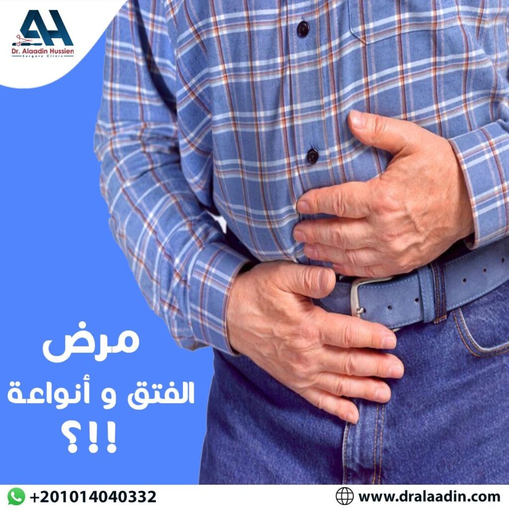 ما أعراض الفتق الخطير