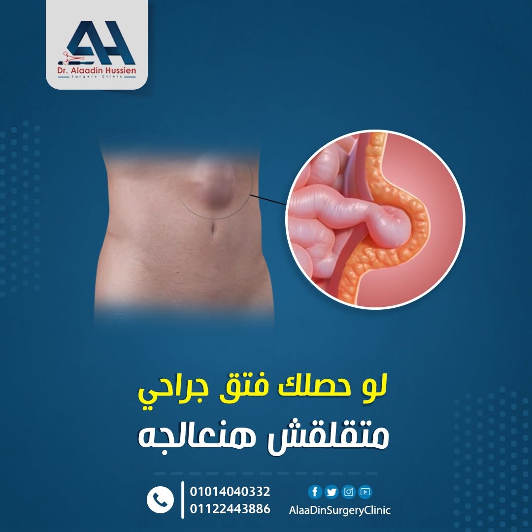 ما أعراض الفتق الخطير