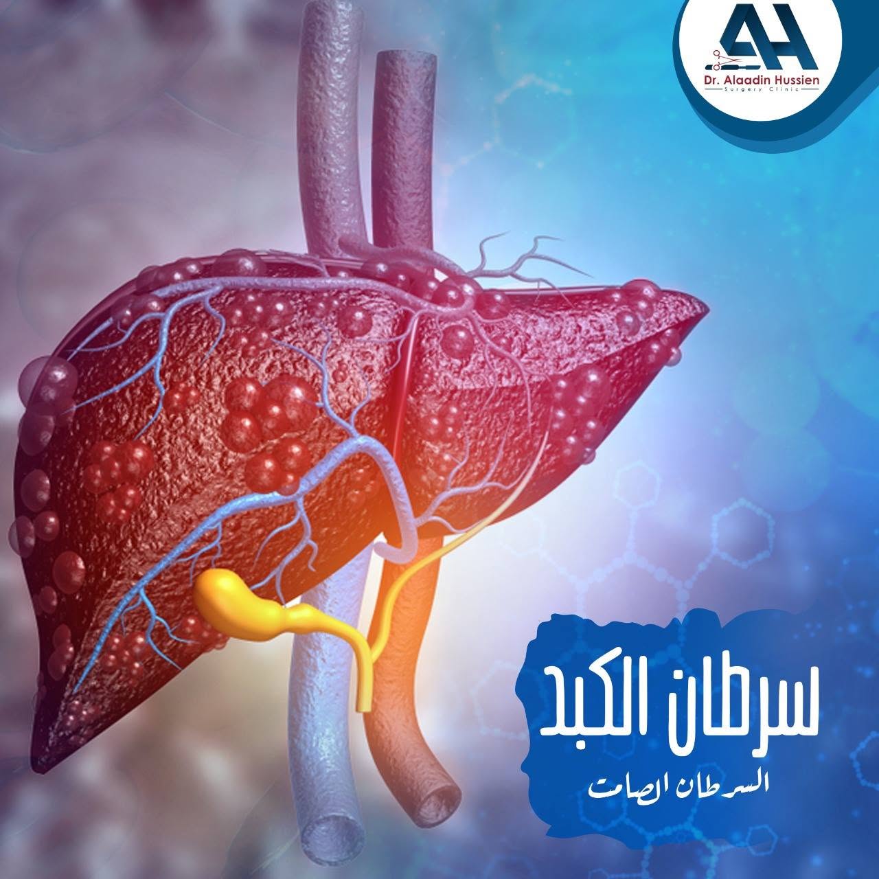 أسباب سرطان الكبد
