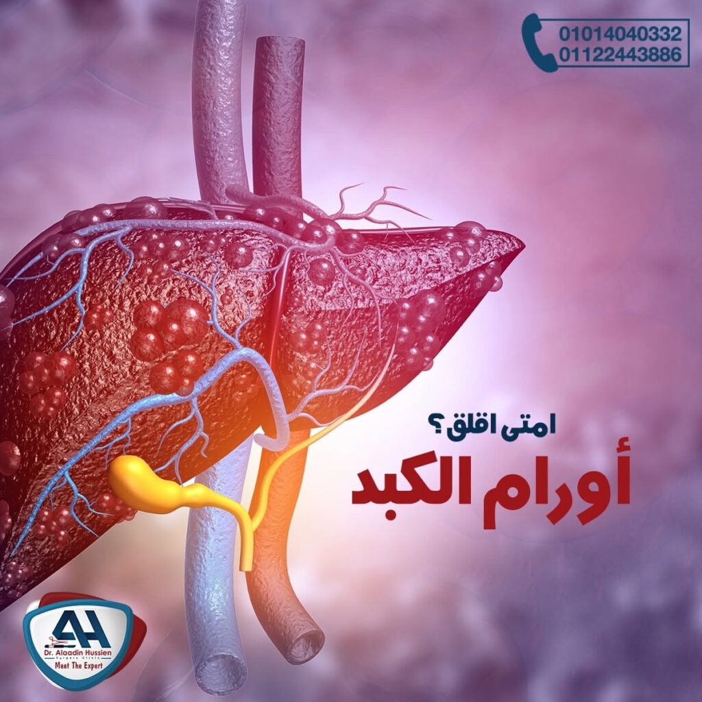 أسباب سرطان الكبد