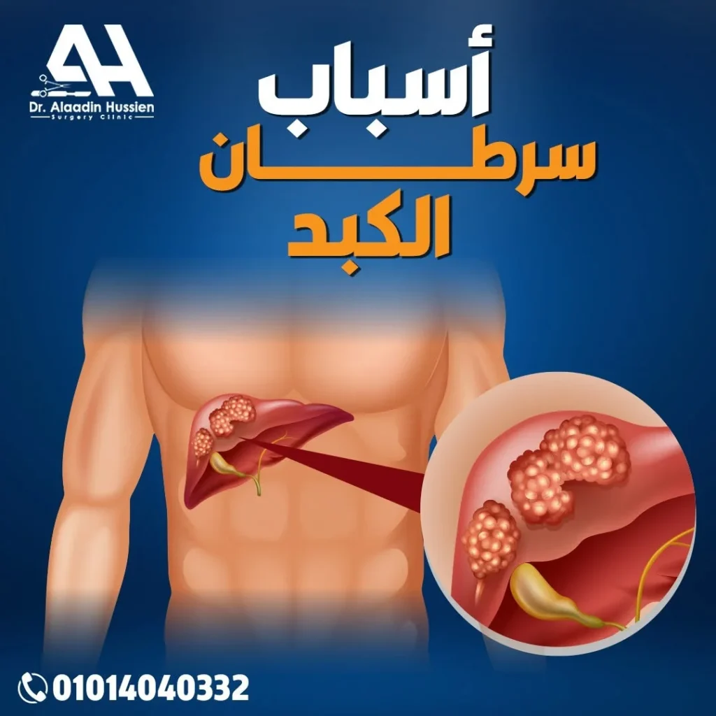 أسباب سرطان الكبد